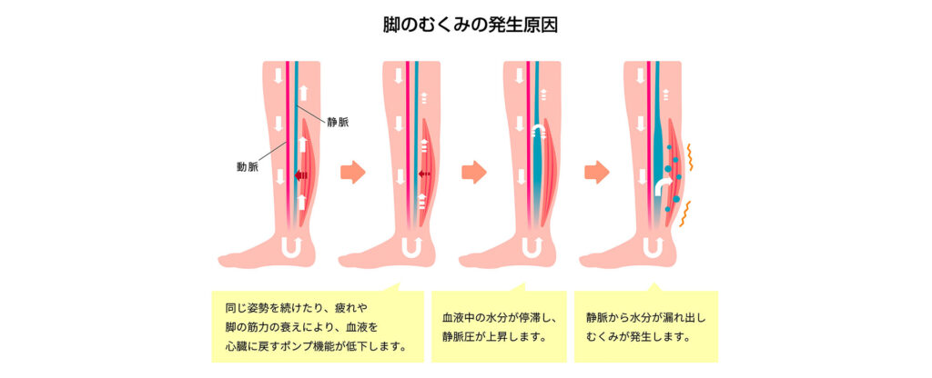 脚のむくみの発生原因